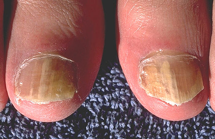 Imagen medica de la CDC con onicomicosis en ambos dedos gordos del pie