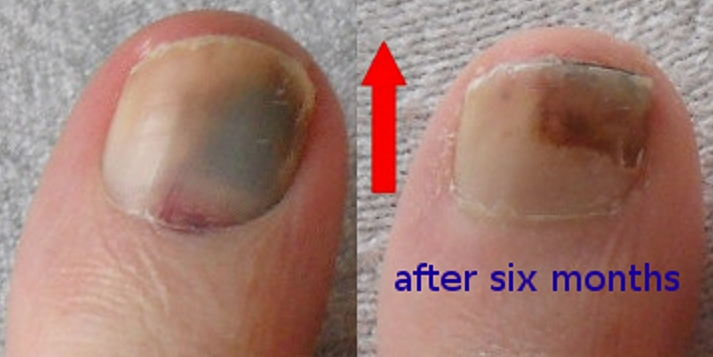 Imagen medica de una una del pie afectada por onicomicosis